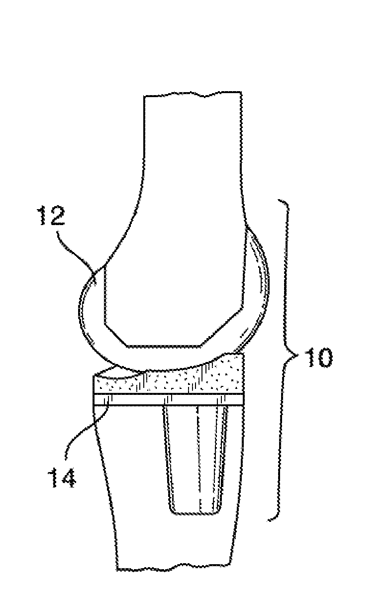 Systems and methods for providing lightweight prosthetic components