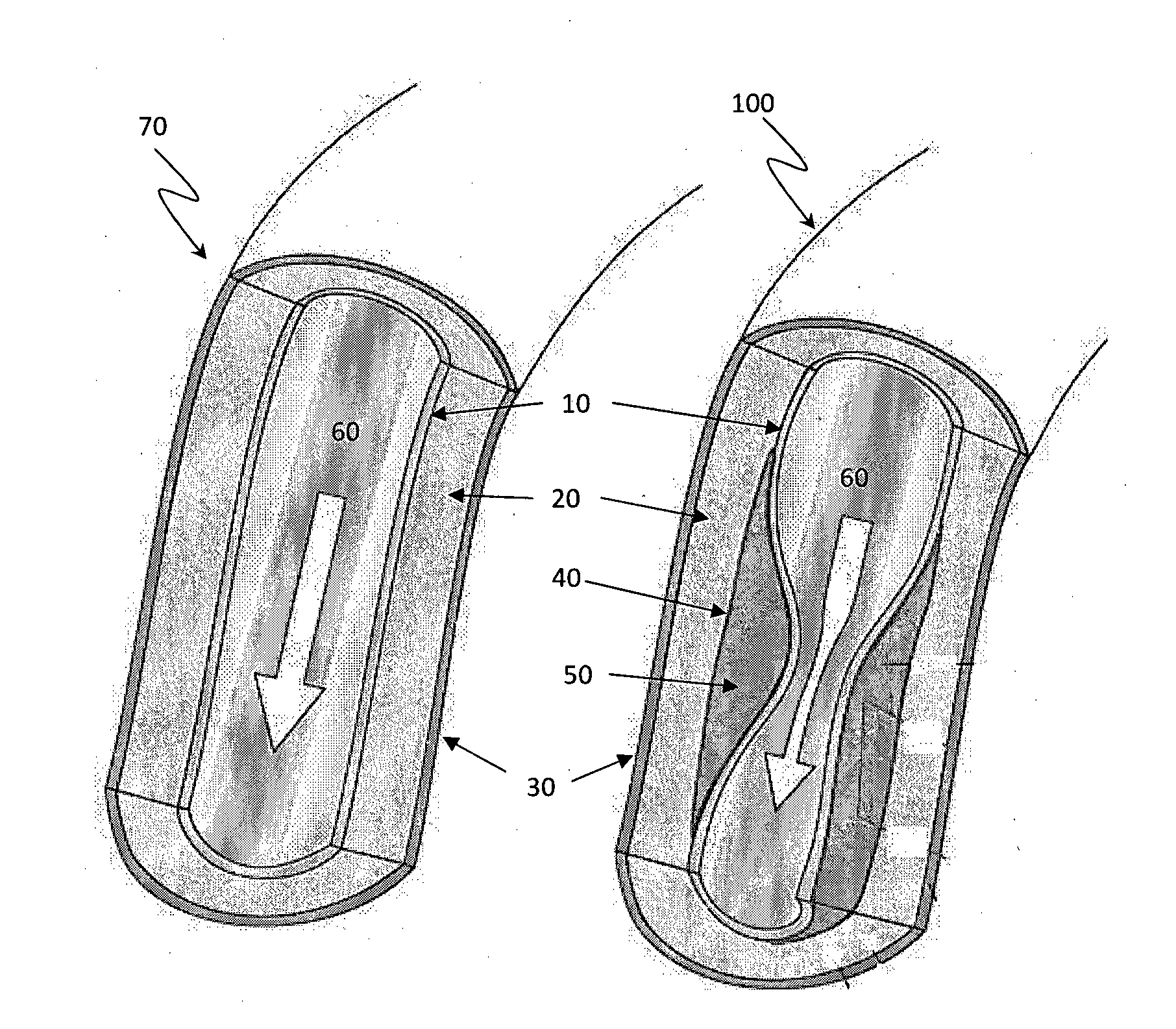 Method and apparatus for eliminating atherosclerosis from a region of the arterial tree