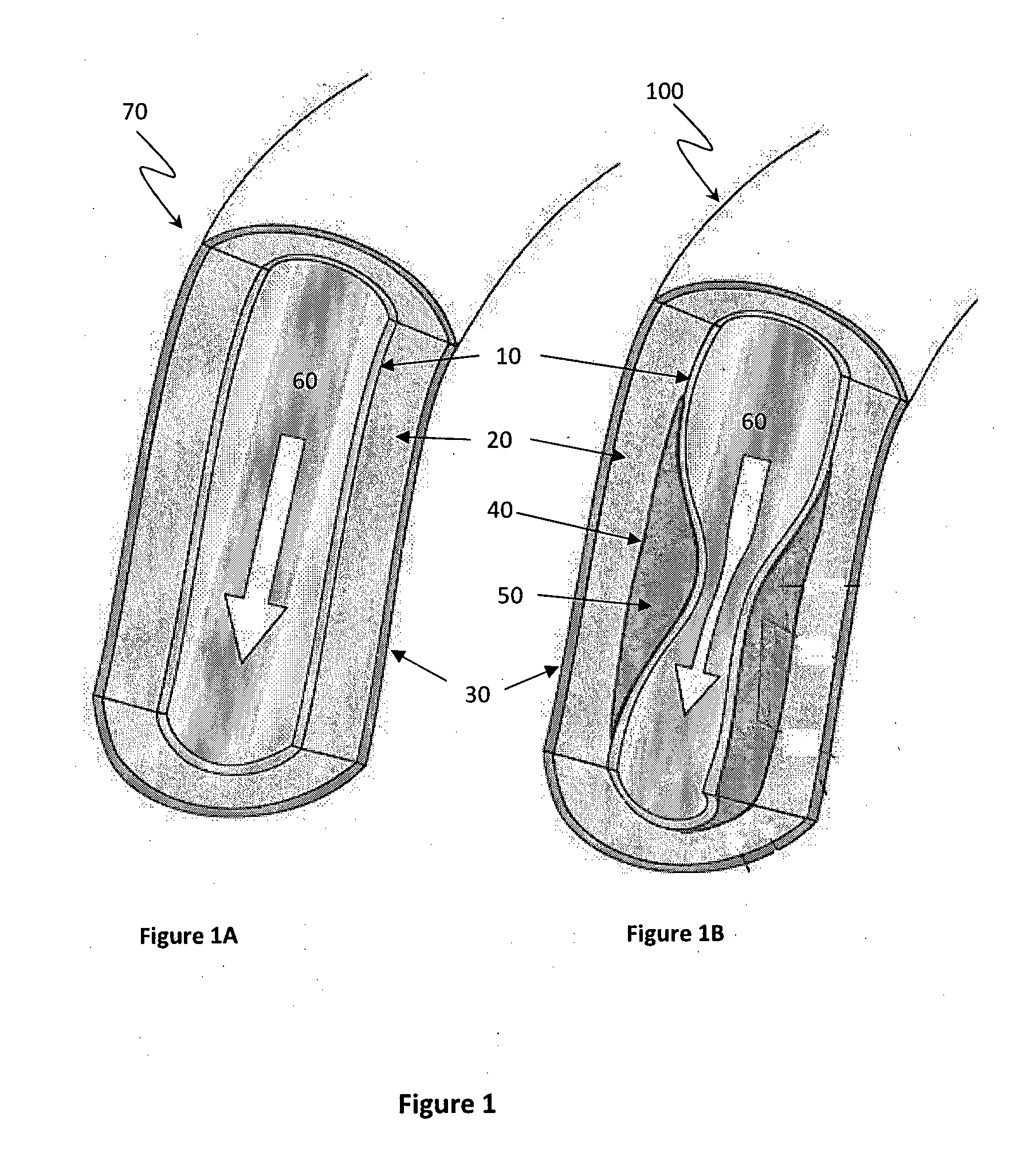 Method and apparatus for eliminating atherosclerosis from a region of the arterial tree