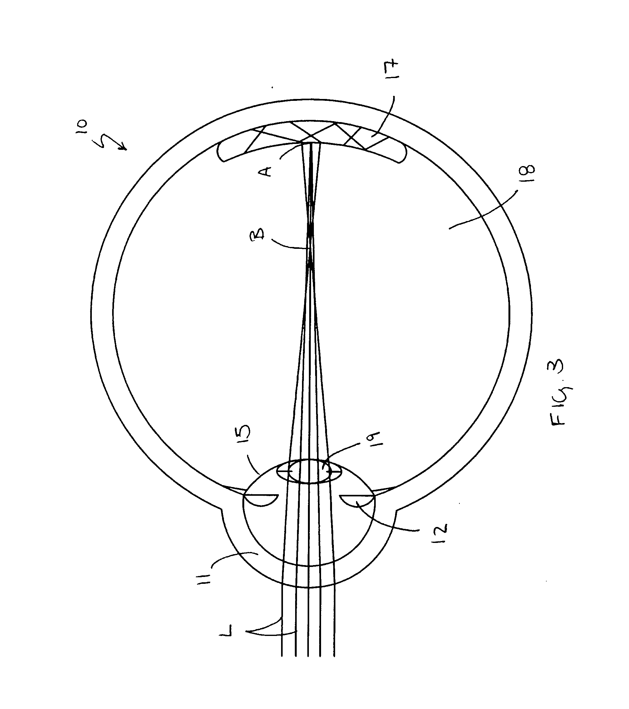Accommodating intraocular lens system having spherical aberration compensation and method