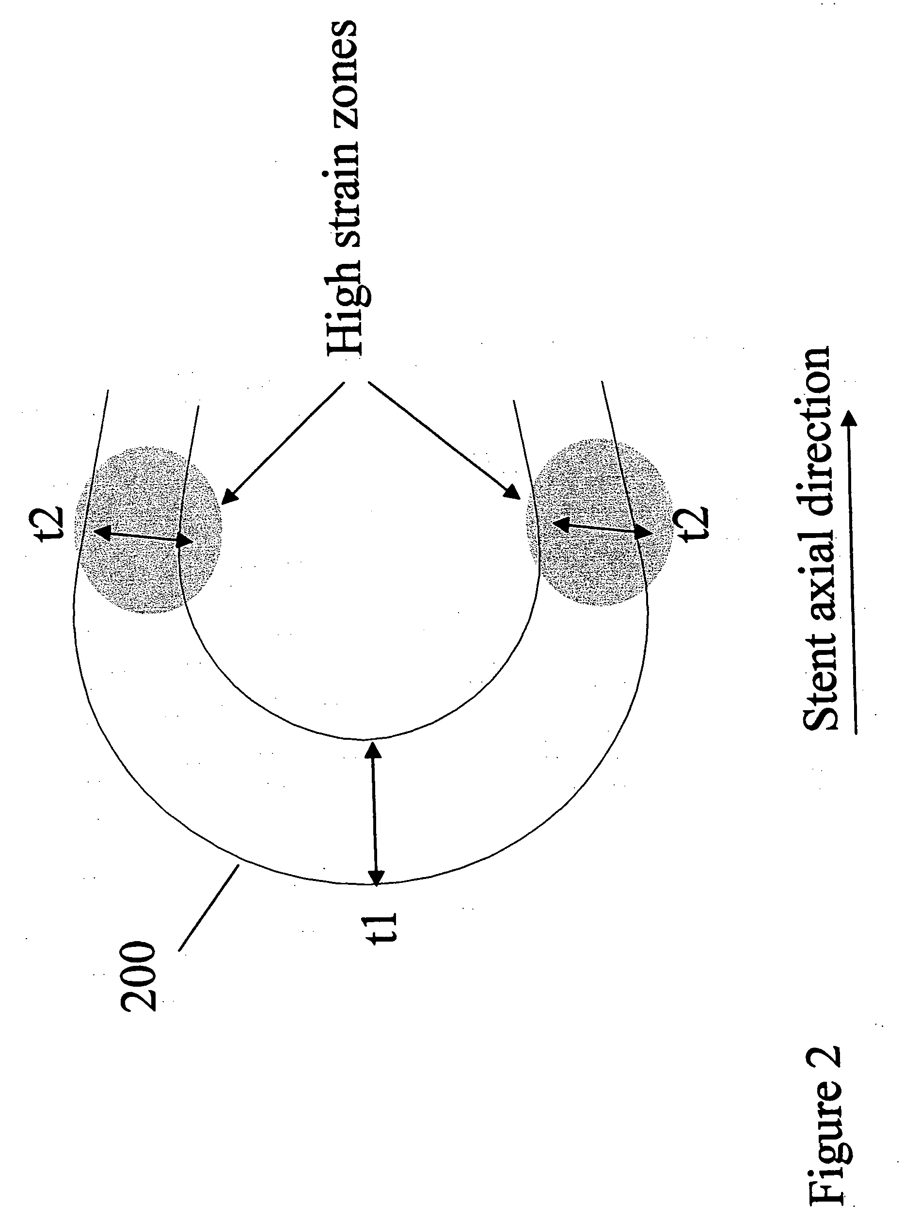Polymeric stent having modified molecular structures in selected regions of the hoops