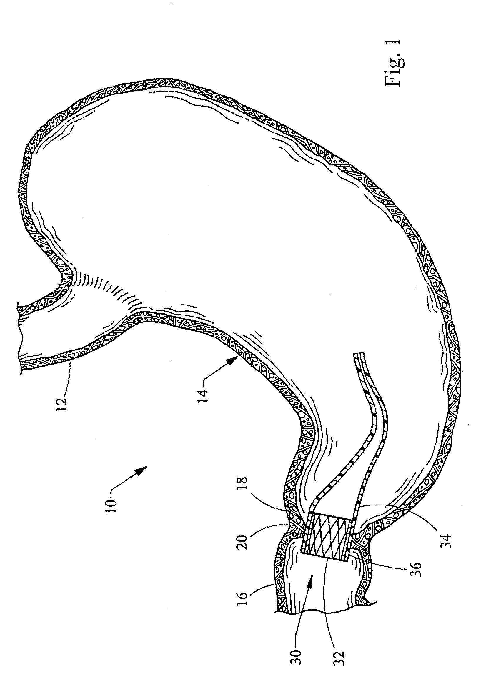 Apparatus and methods for delaying gastric emptying to treat obesity