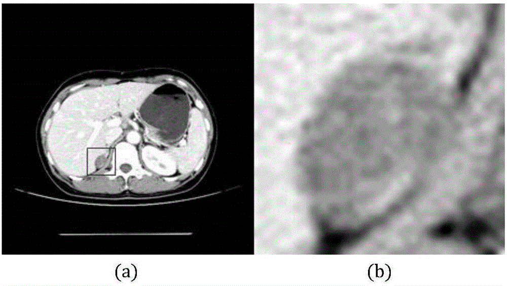 Method for segmenting adrenal tumor of medical CT (computed tomography) image based on sparse representation