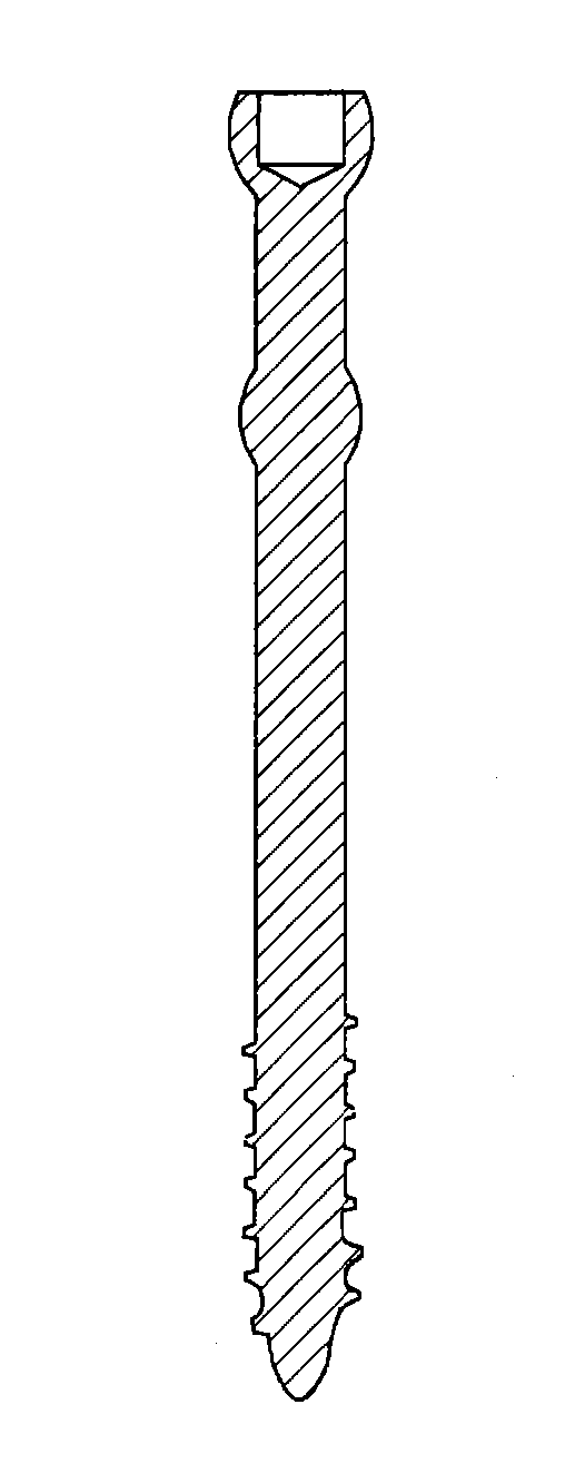 Minimal incision removable bone screw, driver, and method of use