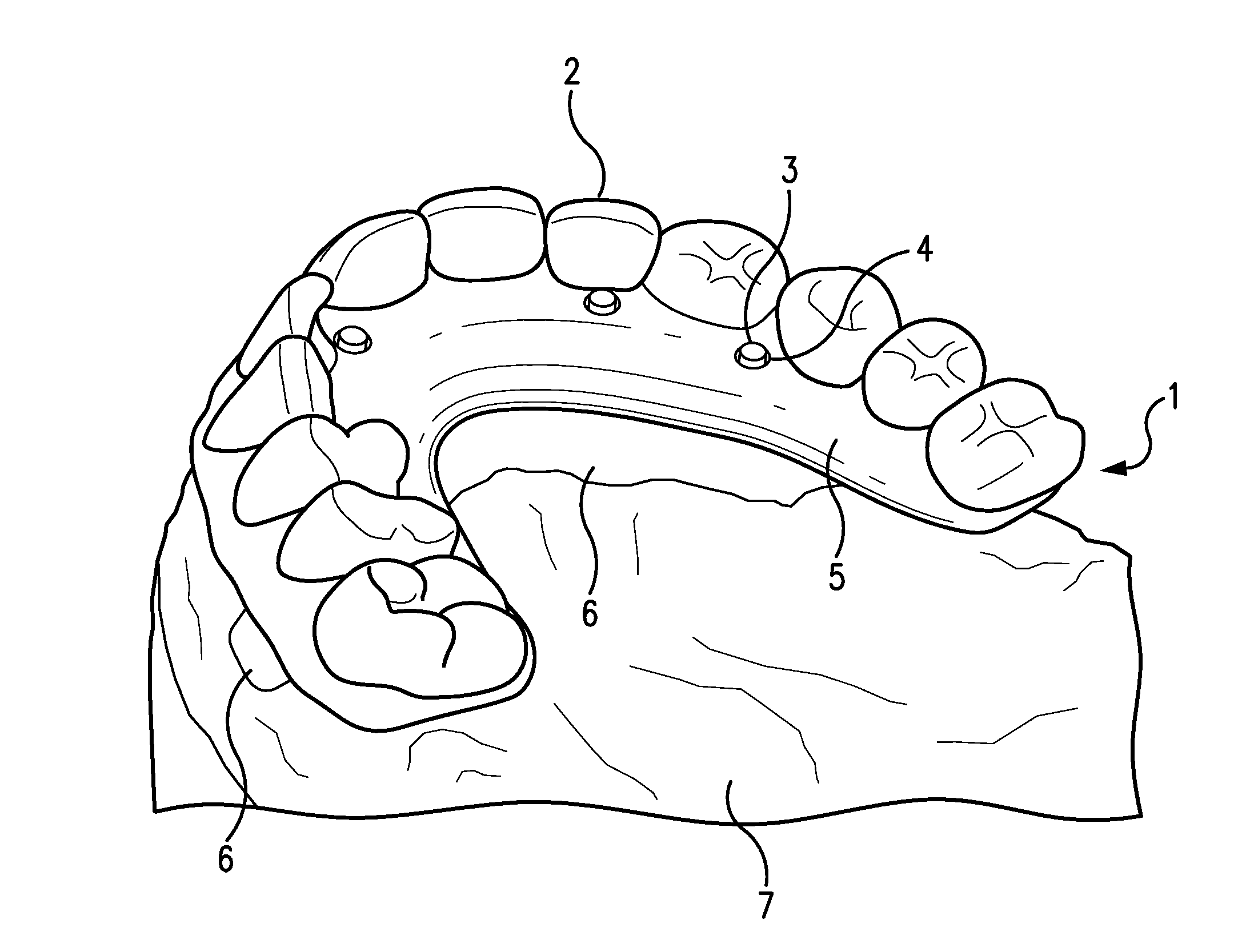 Apparatuses and methods for making a final hybrid prosthesis to be attached to dental implants