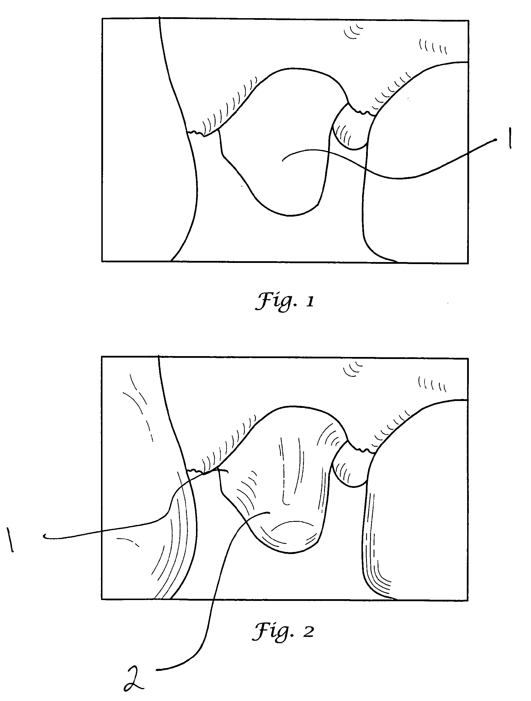 Method of preparing dentition for the taking of a dental impression