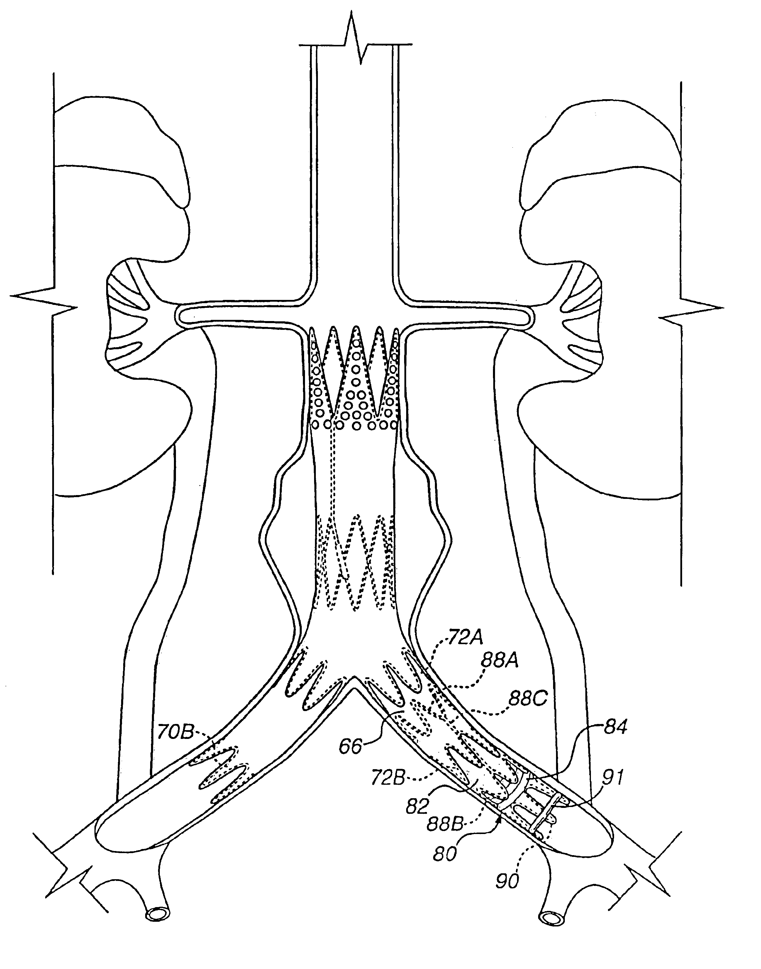 Method for engrafting a blood vessel