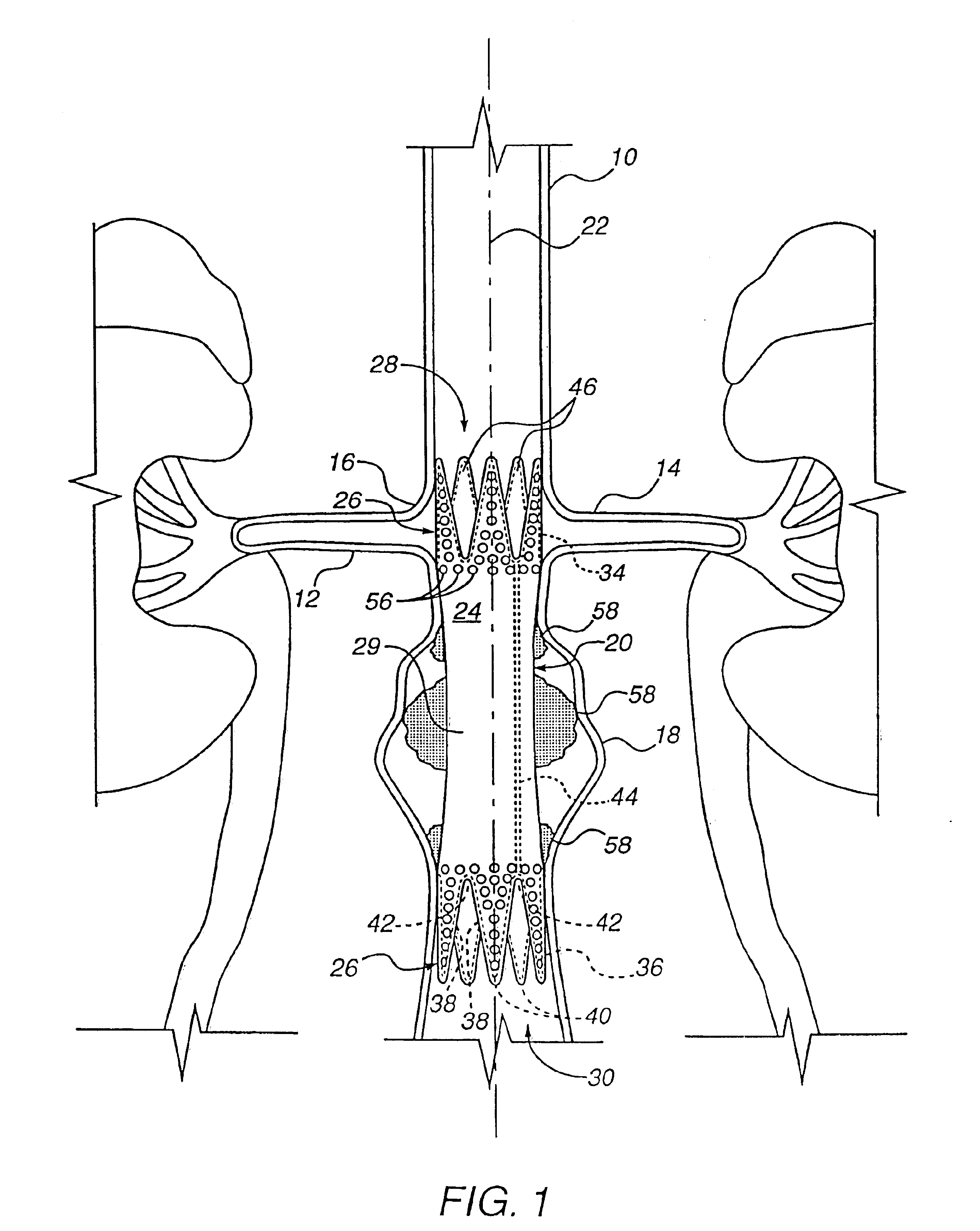 Method for engrafting a blood vessel