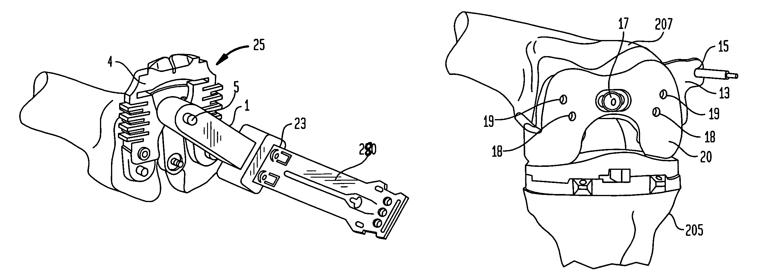 Method for setting the rotational position of a femoral component