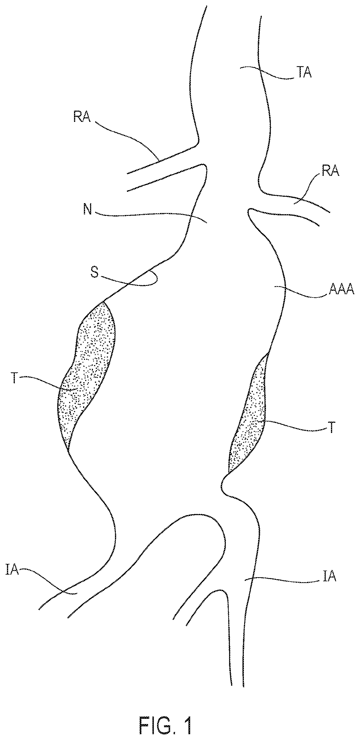 Systems and methods with stent and filling structure