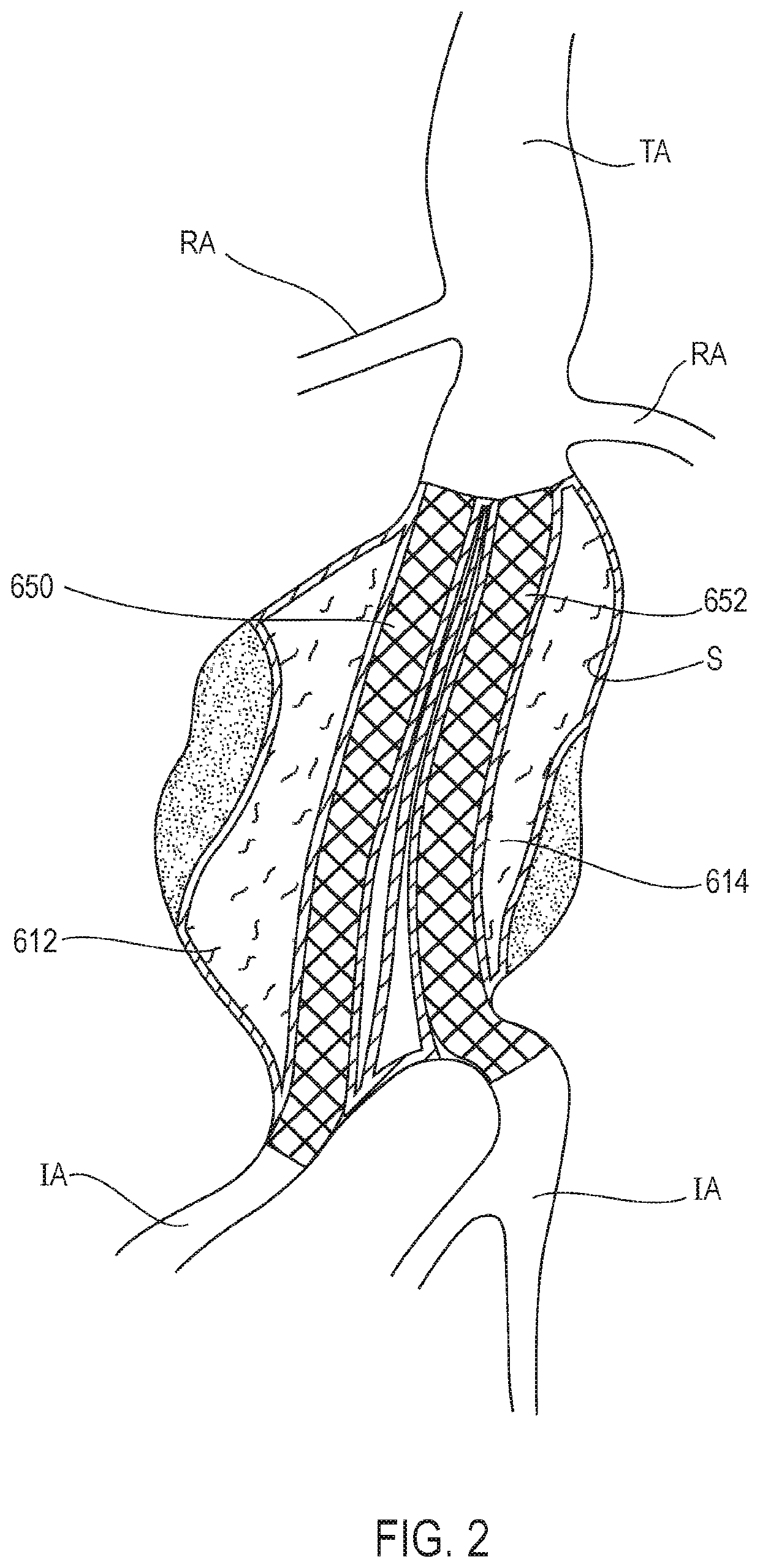 Systems and methods with stent and filling structure