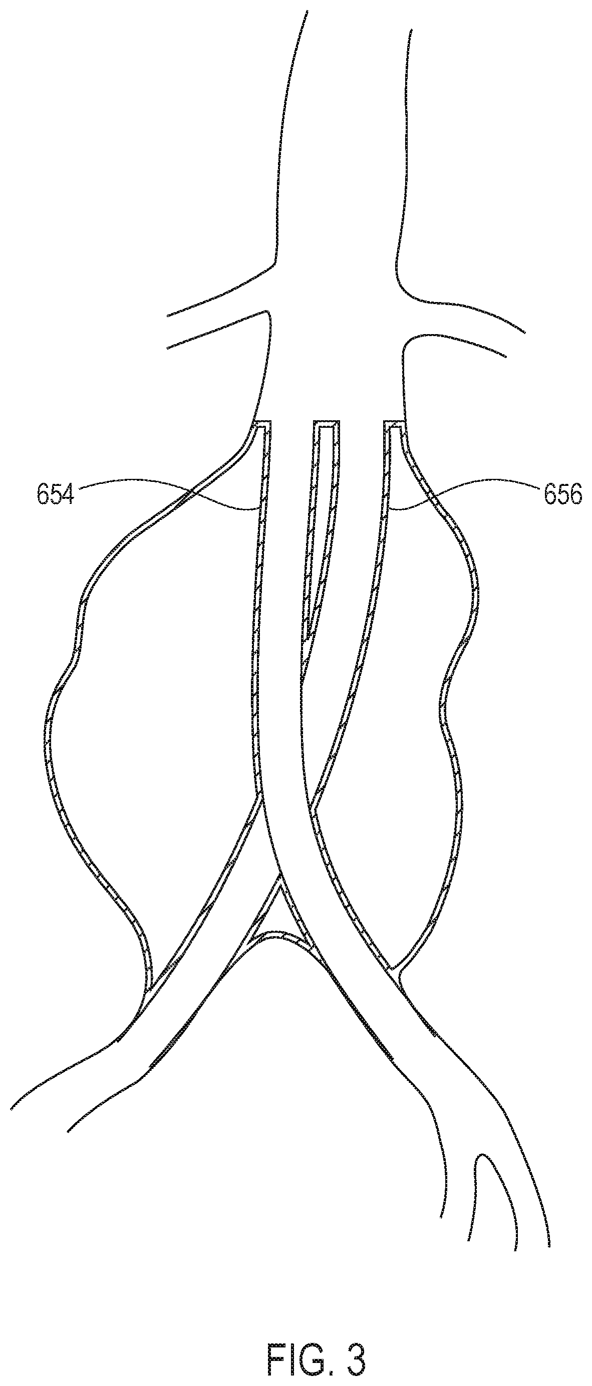 Systems and methods with stent and filling structure