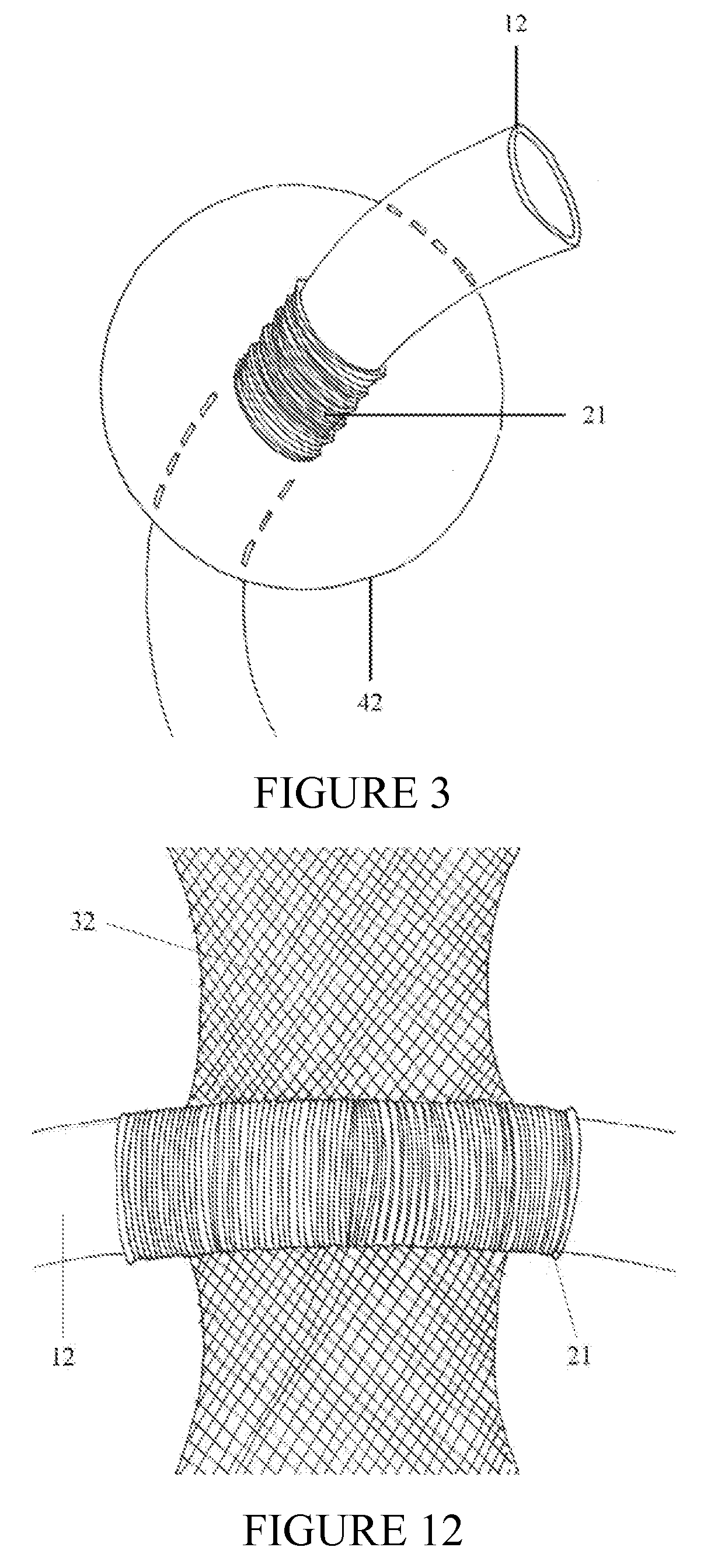 Securement device for shunt catheter and implantation method therefor