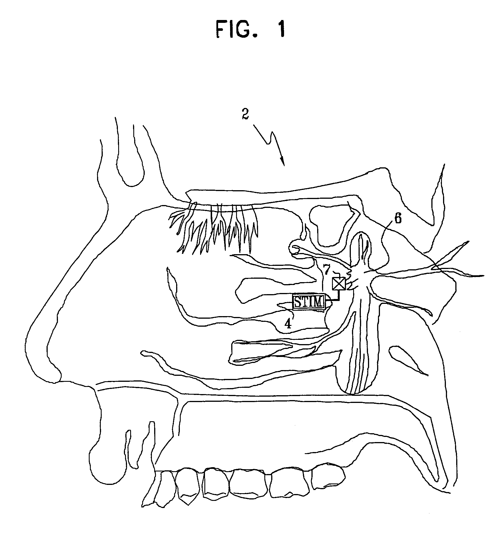 Method and apparatus for stimulating the sphenopalatine ganglion to modify properties of the BBB and cerebral blood flow
