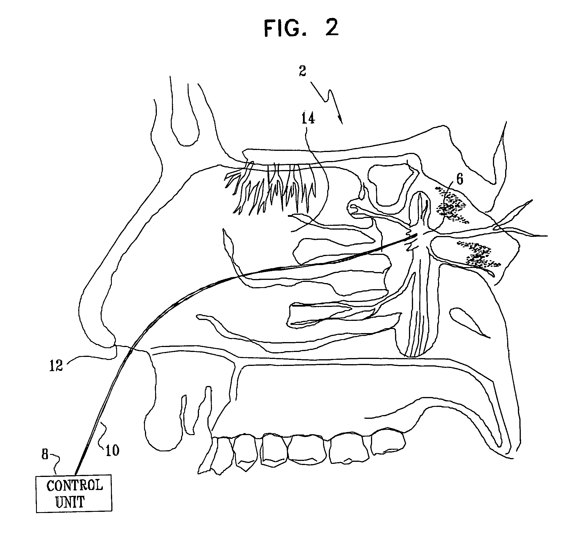 Method and apparatus for stimulating the sphenopalatine ganglion to modify properties of the BBB and cerebral blood flow