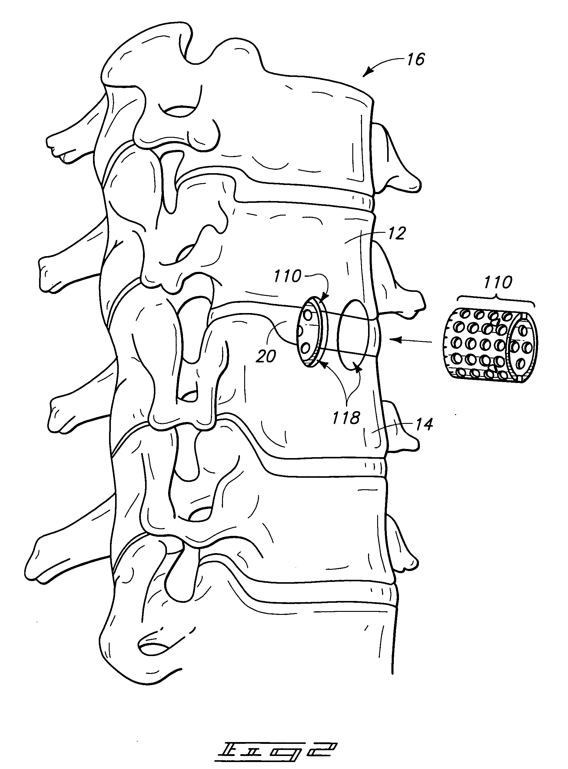 Apparatus and method for preparing a spinal implant surgical site for receiving a spinal fusion implant