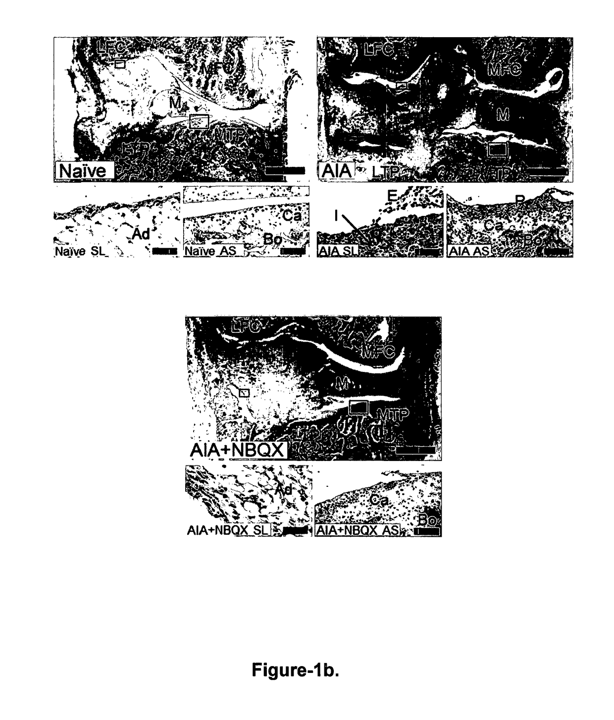 Methods and compounds for preventing osteoarthritis