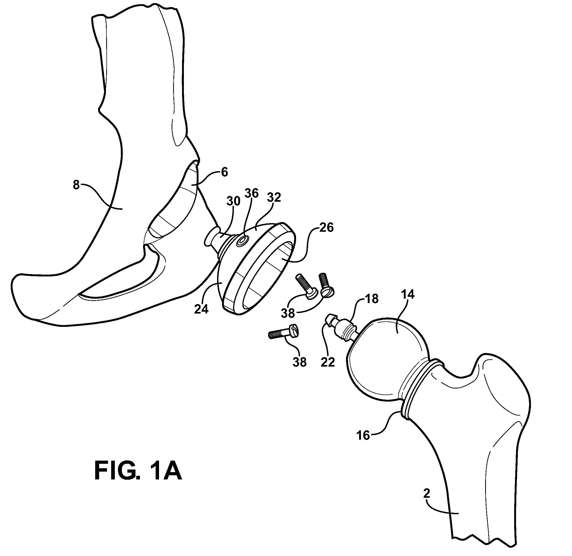 Hip socket with assembleable male ball shape having integrally formed ligament and female receiver and installation kit