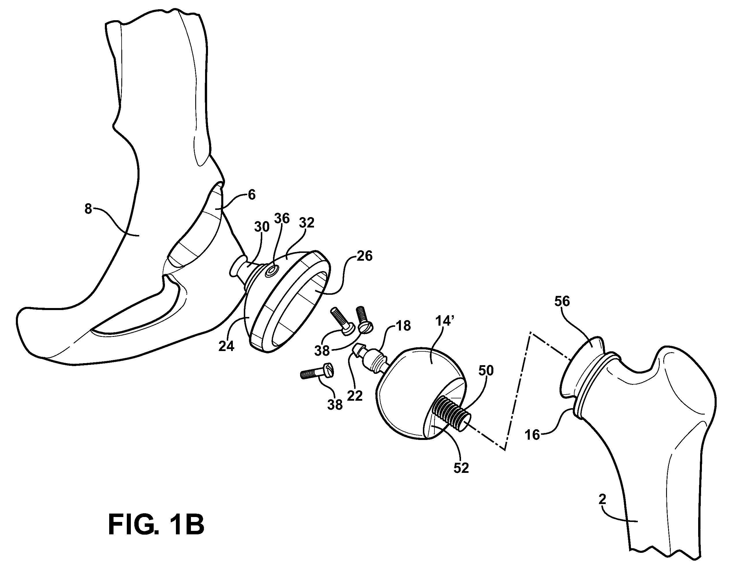 Hip socket with assembleable male ball shape having integrally formed ligament and female receiver and installation kit