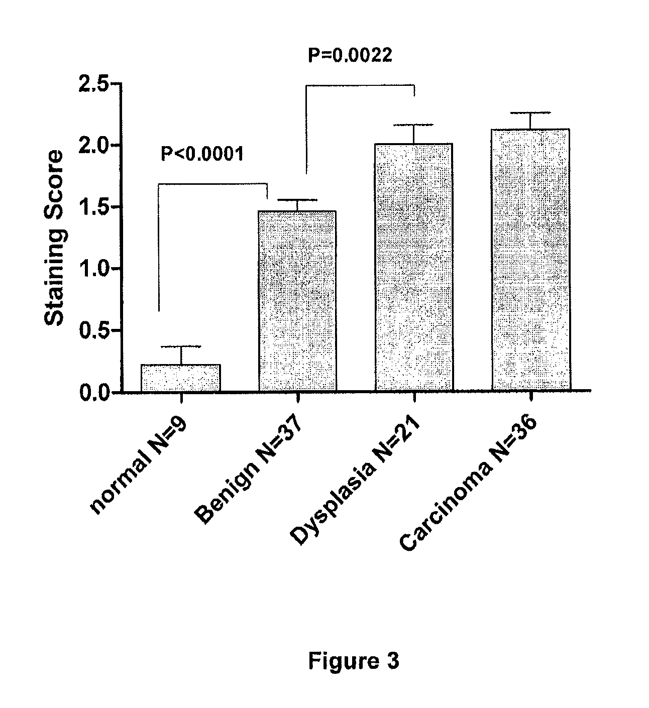 G-protein coupled receptor-associated sorting protein 1 as a cancer biomarker