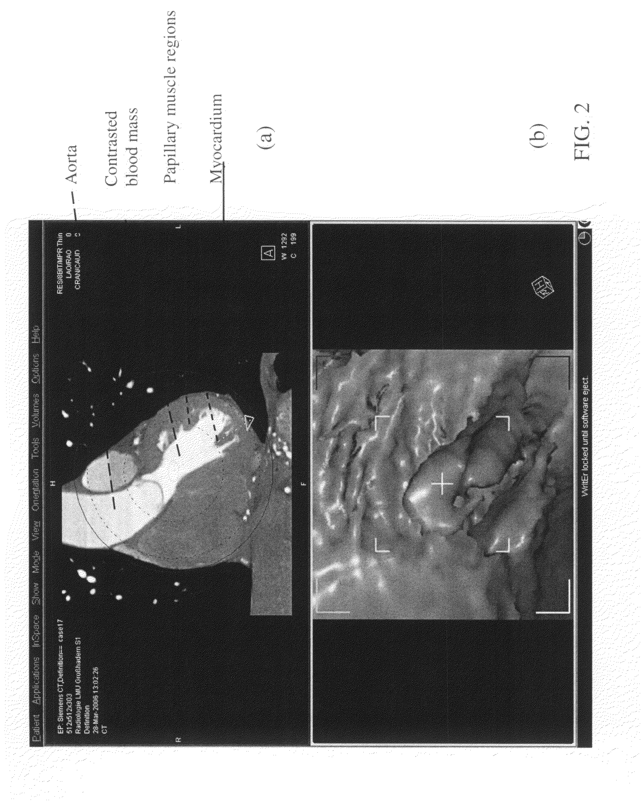 Method and system for performing ablation to treat ventricular tachycardia