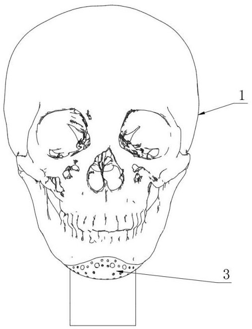 Method for making model by craniomaxillofacial filling prosthesis