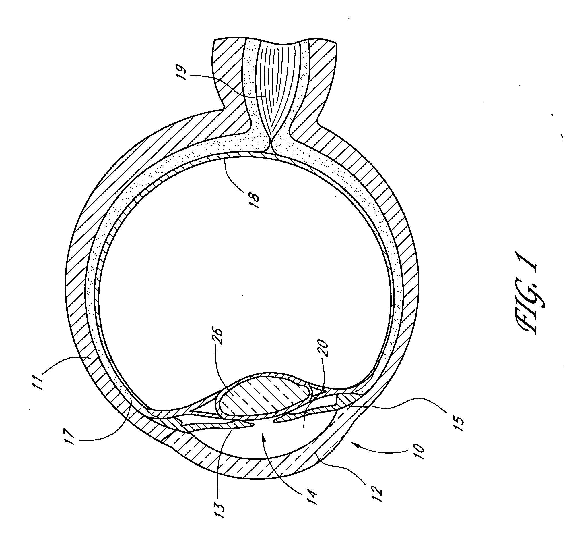 Glaucoma stent system
