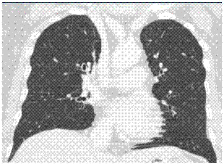 CT image-based lung lobe segmentation method and device
