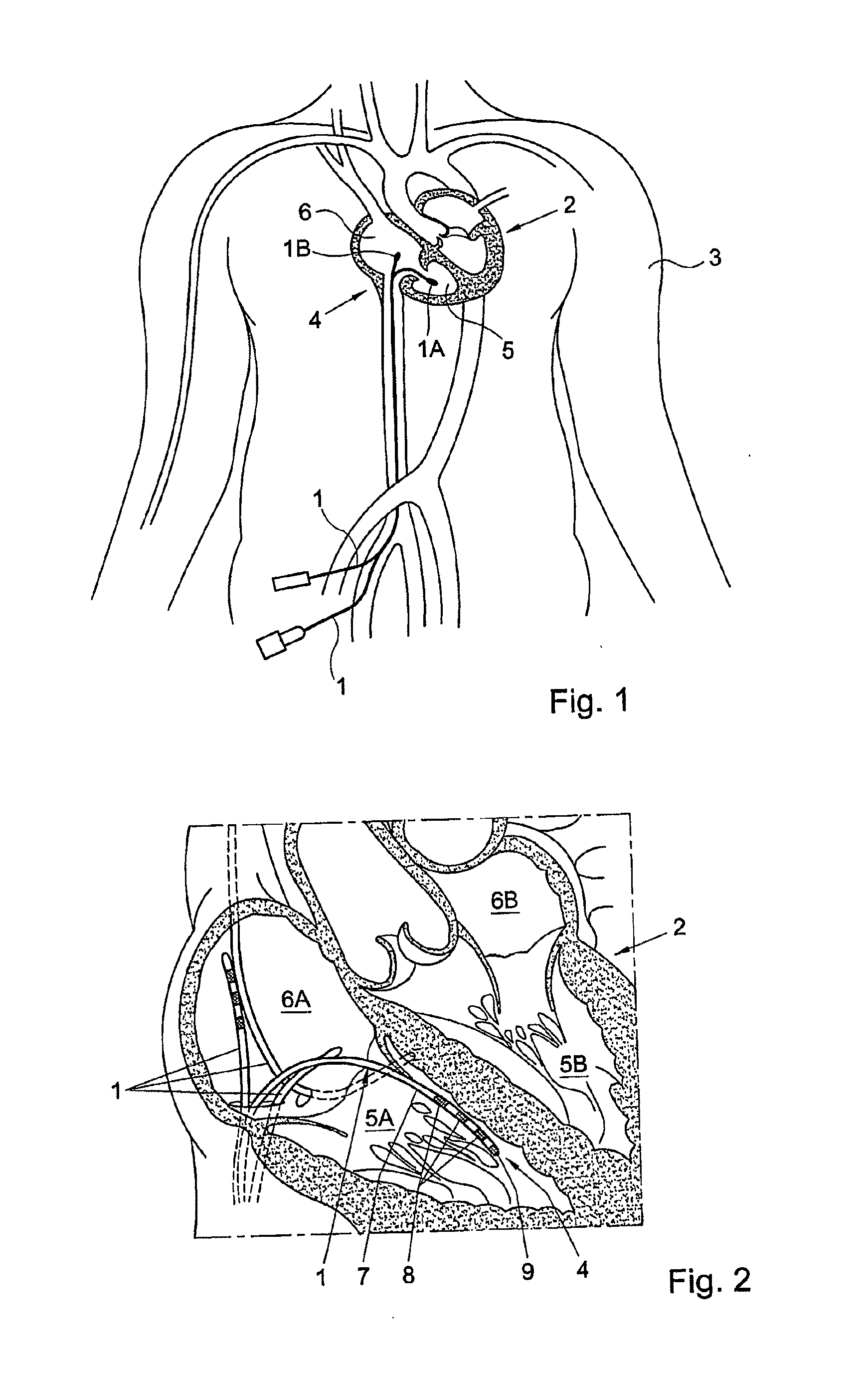 Irrigated catheter and method, in particular for ablation and like techniques