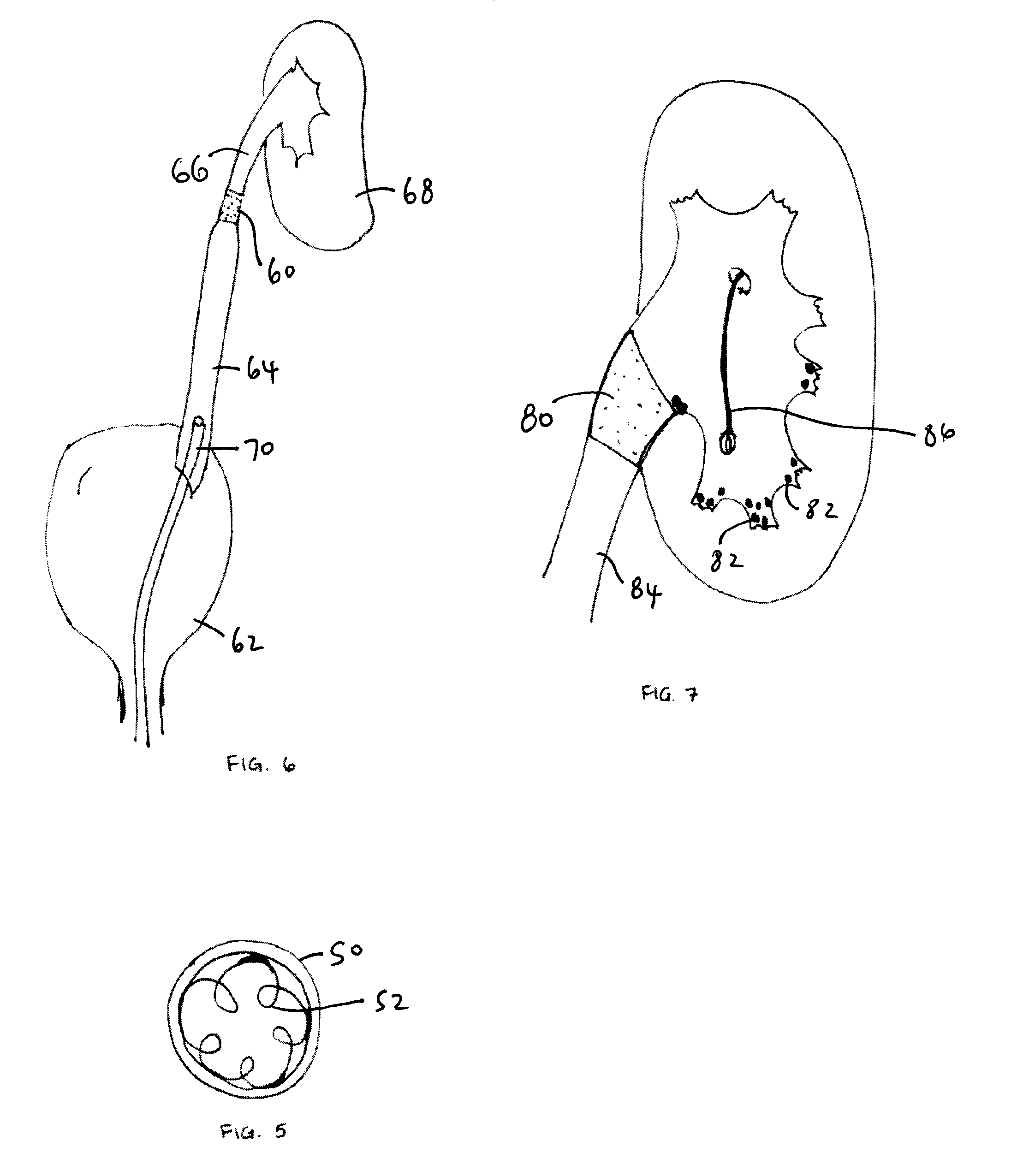 Methods and apparatus for temporarily occluding body openings
