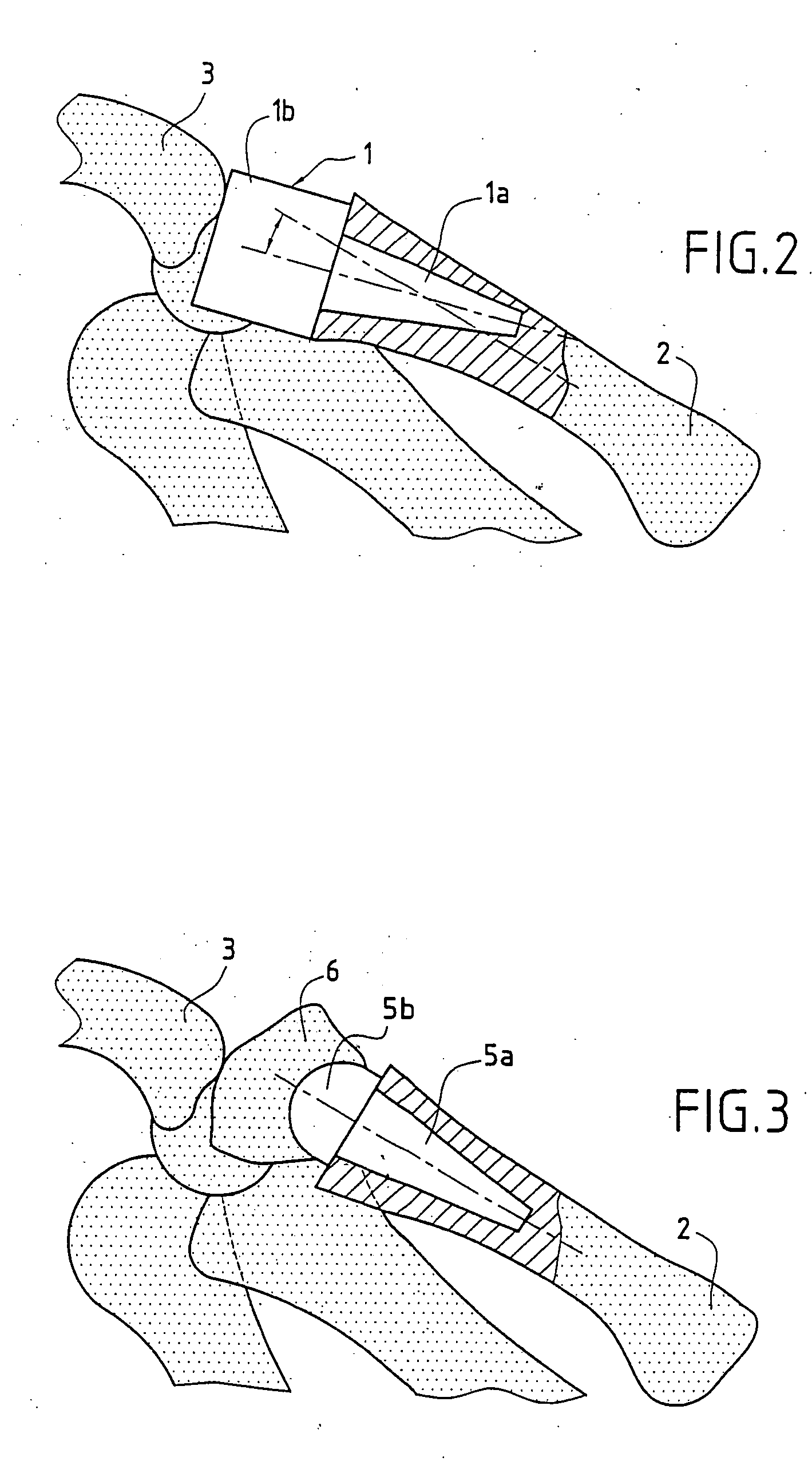 Trapezal or trapezo-metacarpal implant