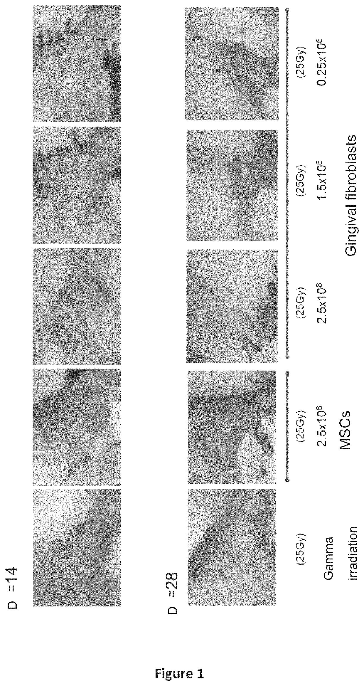 Use of gingival fibroblasts in the treatment of alopecia