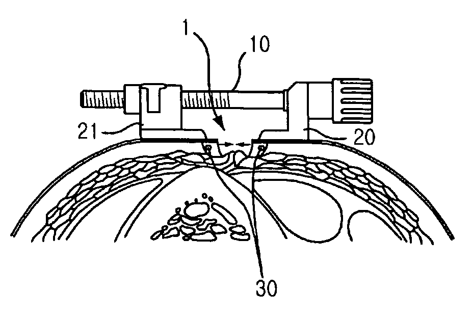 Wound Closure Assisting and Maintaining Apparatus