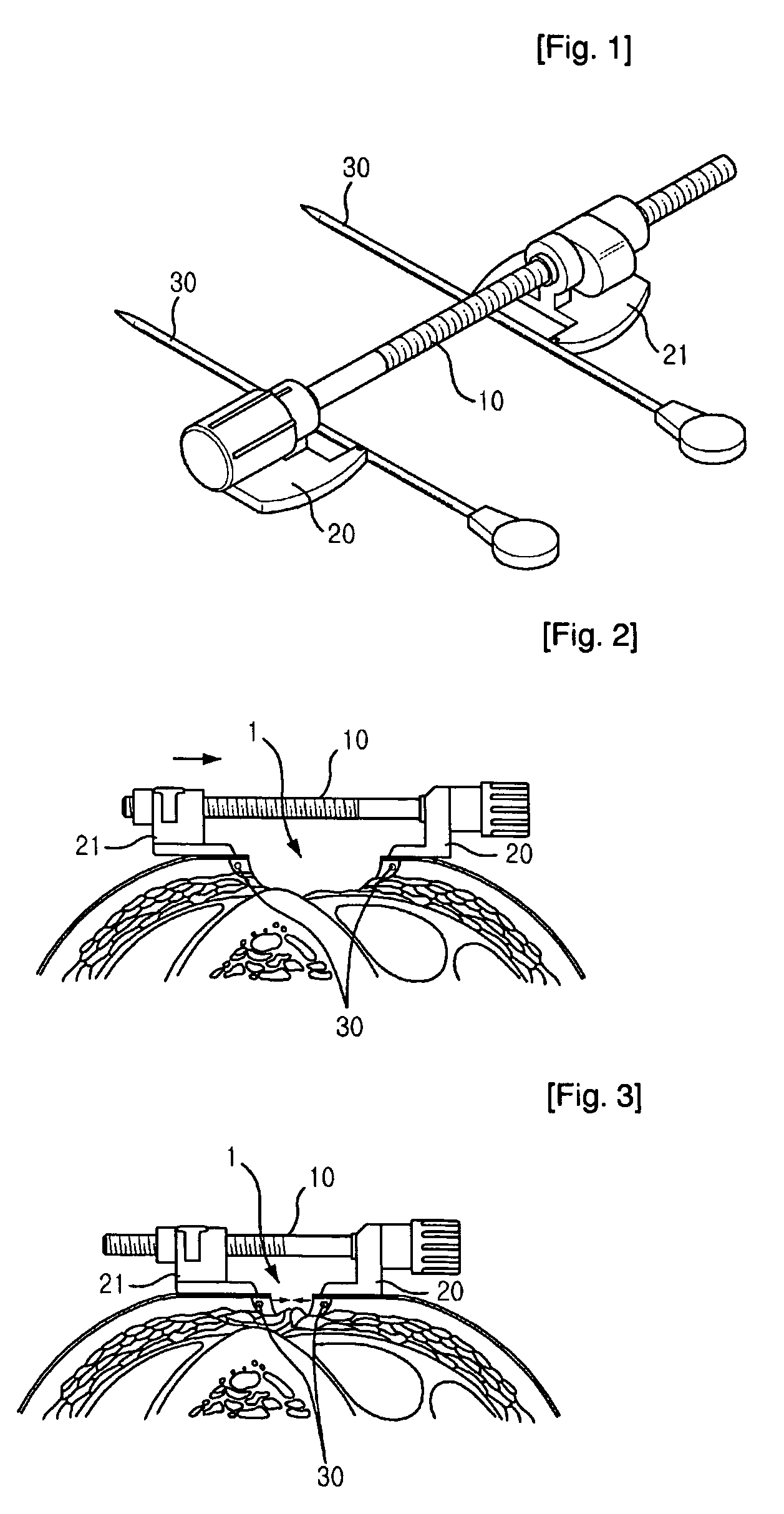Wound Closure Assisting and Maintaining Apparatus