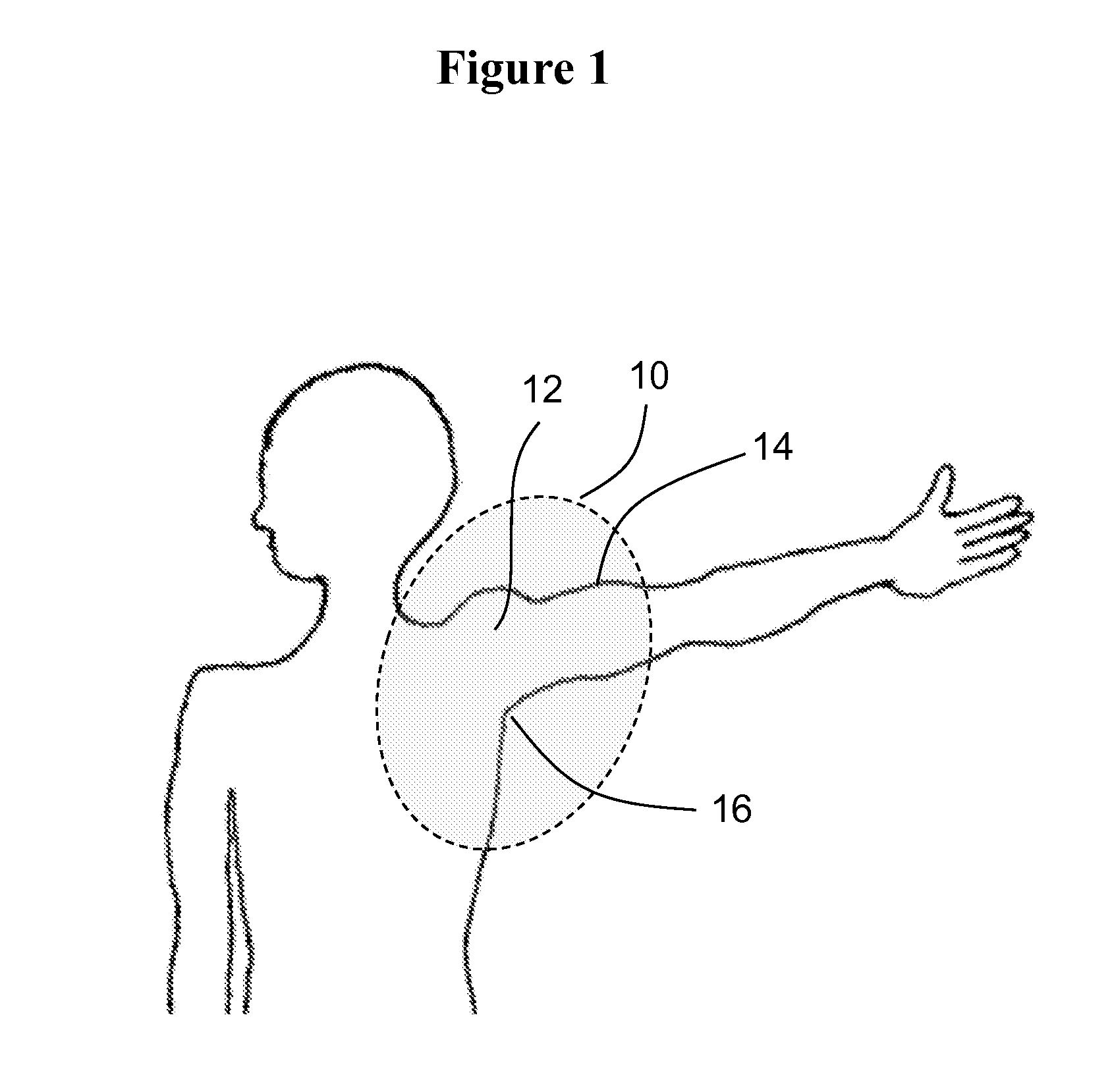 Methods and materials for reducing the risk of infections