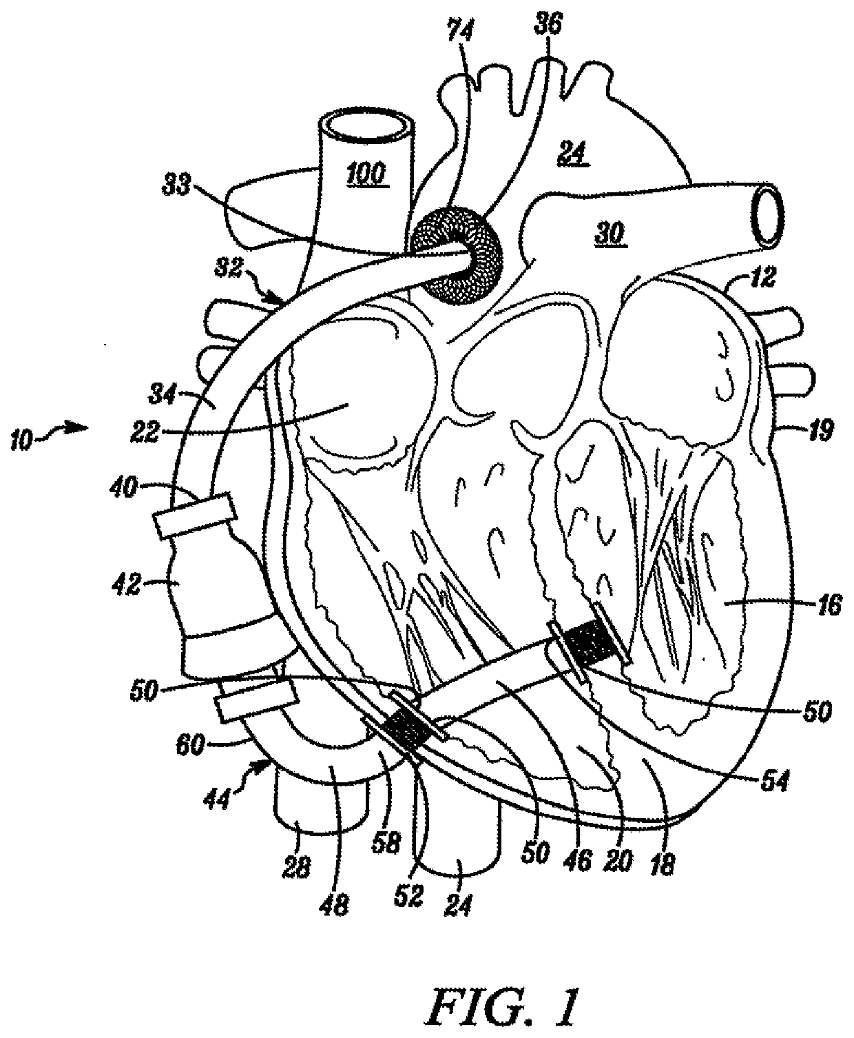 Percutaneous long term left ventricular assist device and non-invasive method for implanting same