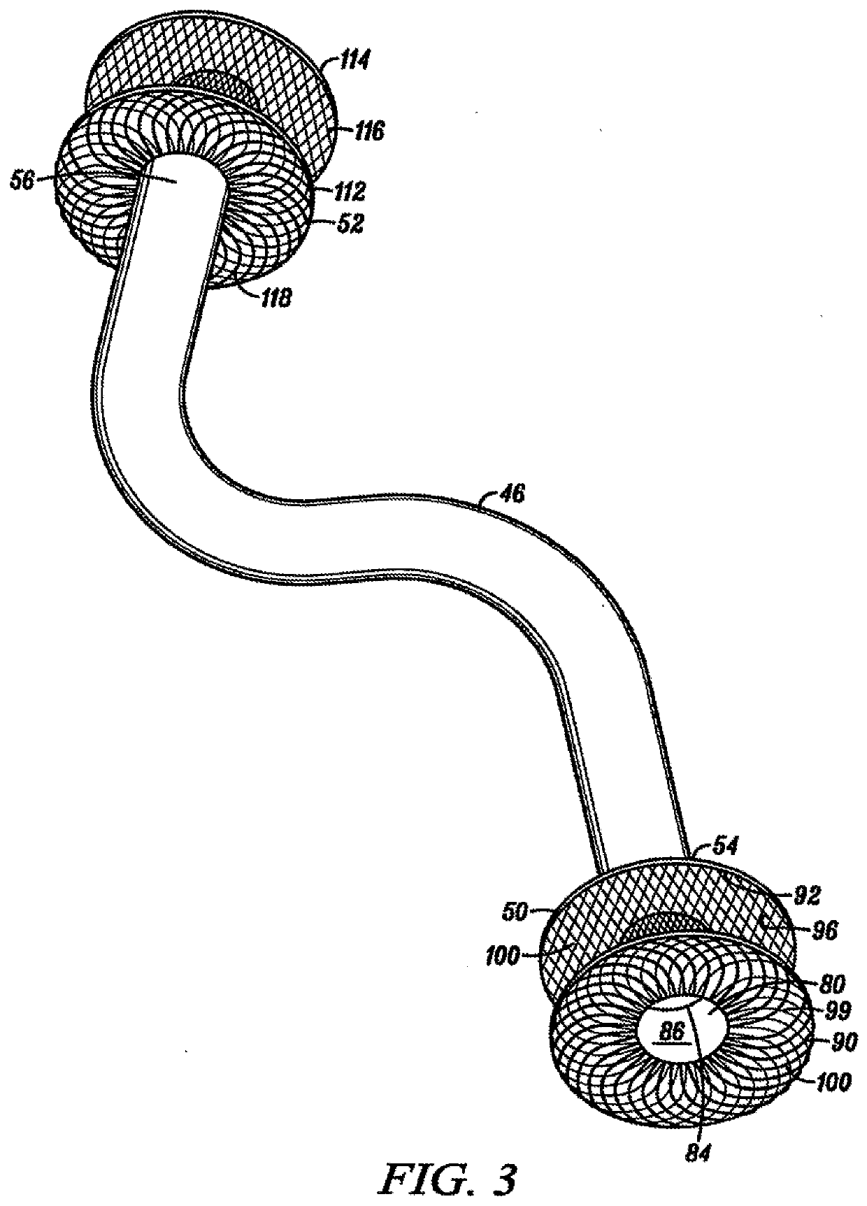 Percutaneous long term left ventricular assist device and non-invasive method for implanting same