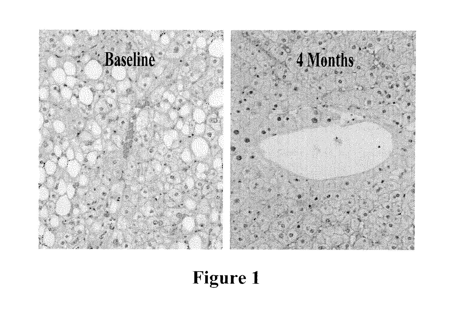 Method of treating fatty liver diseases and conditions in non-lipodystrophic subjects