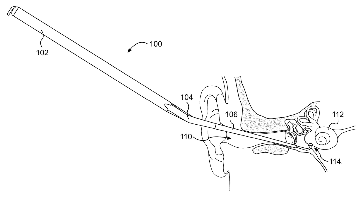 System for inner ear drug delivery via trans-round window membrane injection