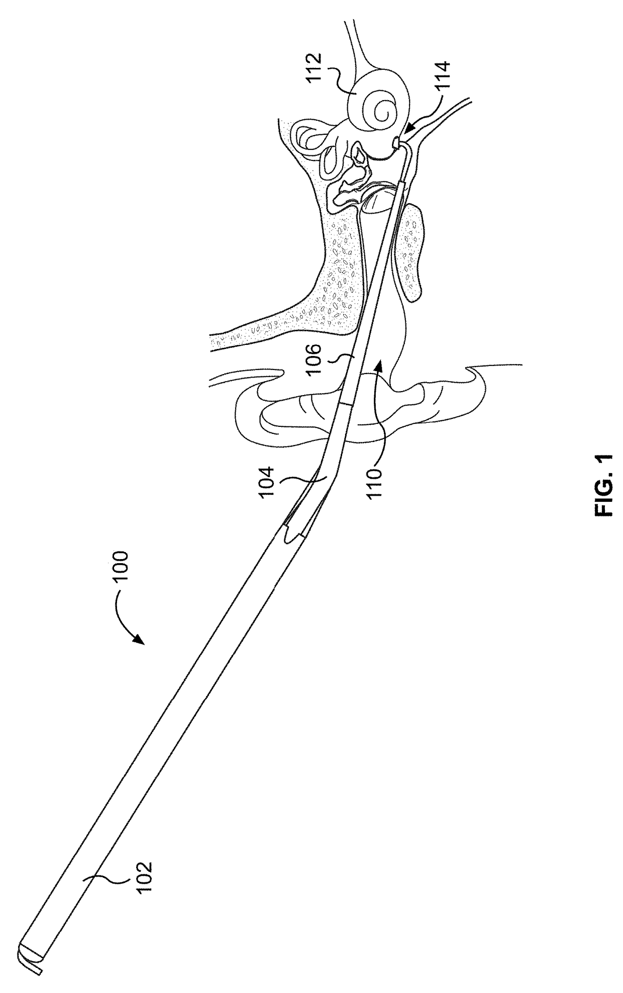 System for inner ear drug delivery via trans-round window membrane injection
