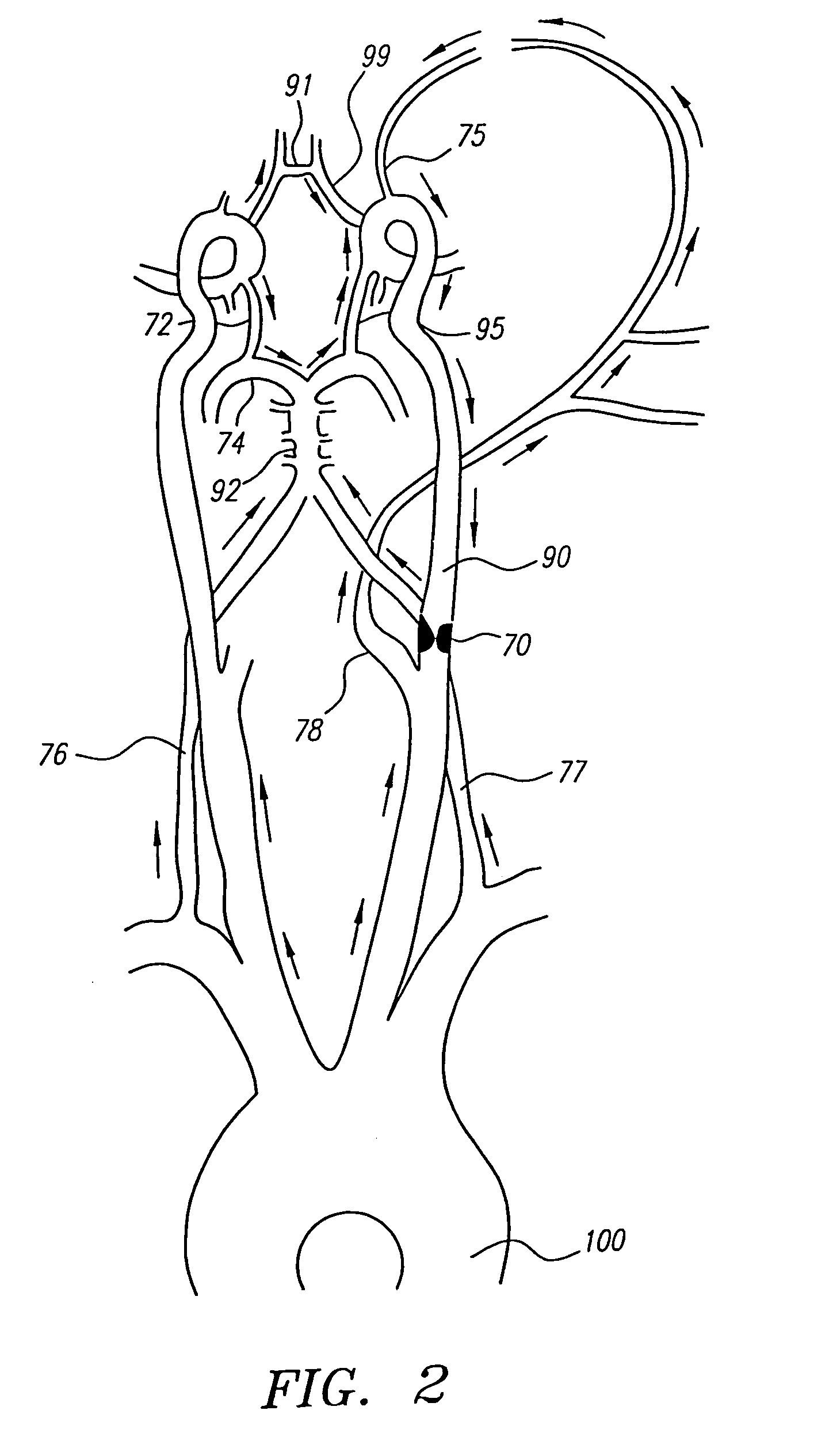 Devices and methods for preventing distal embolization during interventional procedures