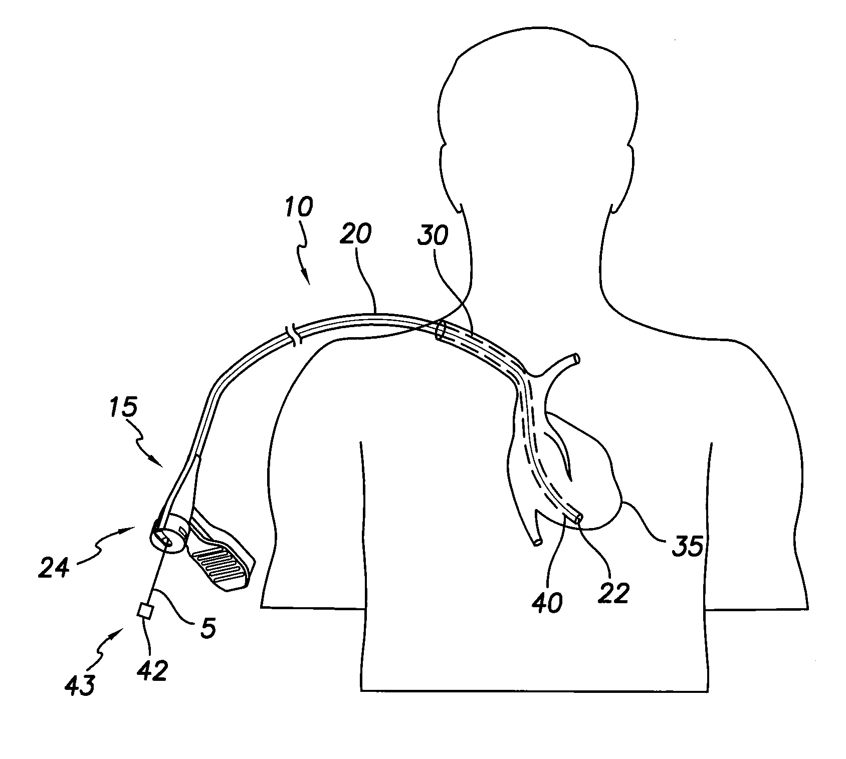 Slittable delivery device for the delivery of a cardiac surgical device