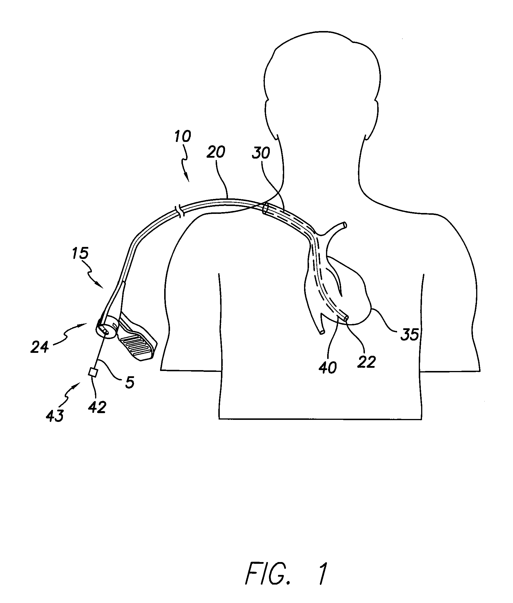 Slittable delivery device for the delivery of a cardiac surgical device