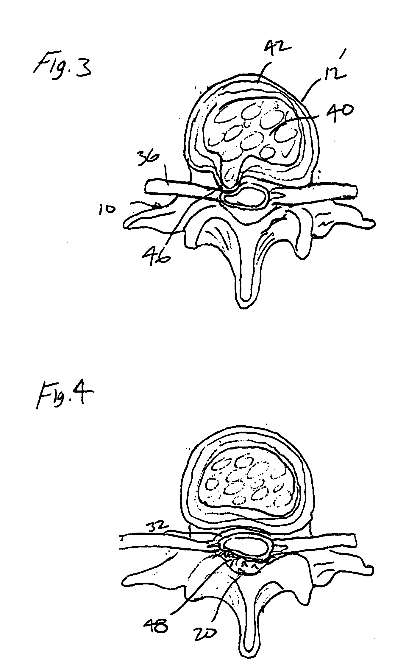 Articulating tissue removal probe and methods of using the same