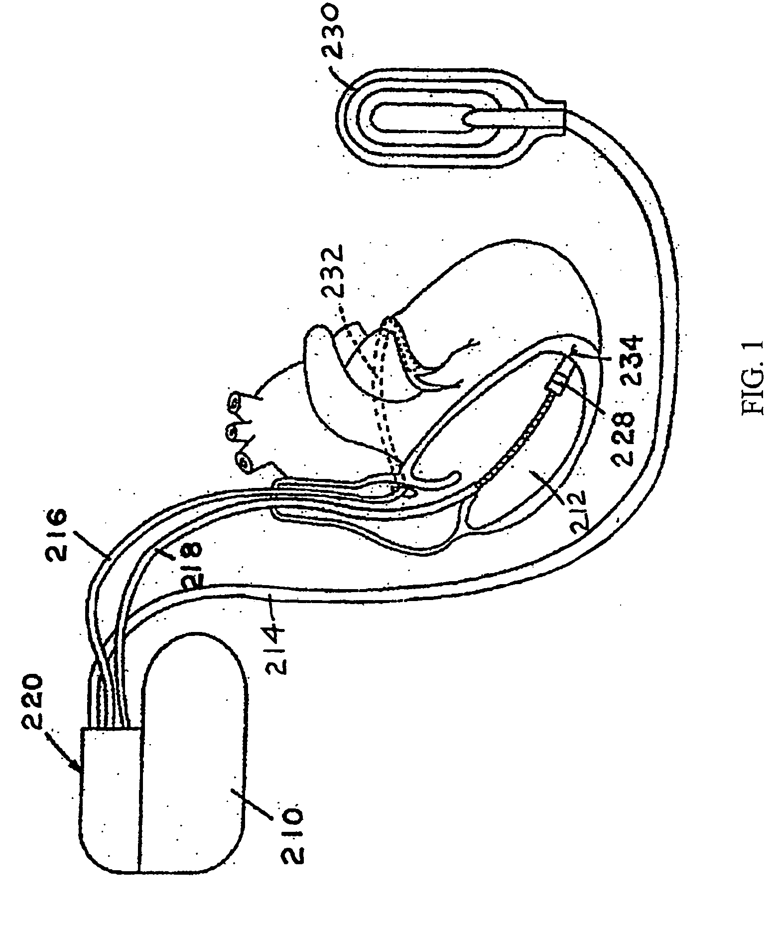 Method and apparatus for laser welding incorporating galvanometer delivery