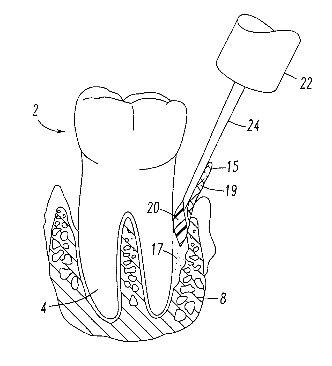 Periodontal regeneration composition and method of using same