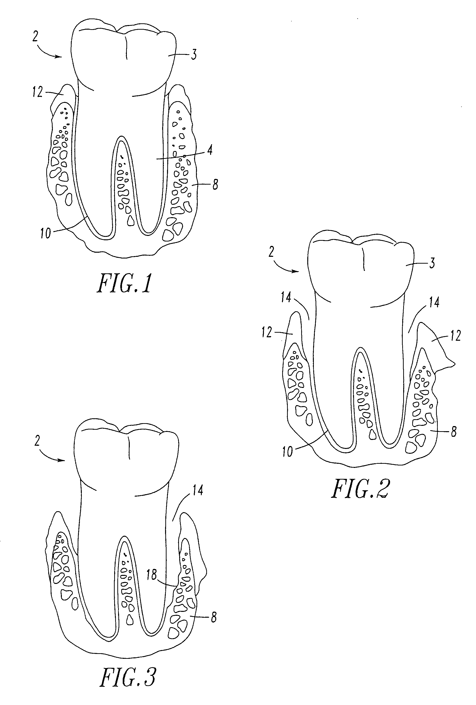 Periodontal regeneration composition and method of using same