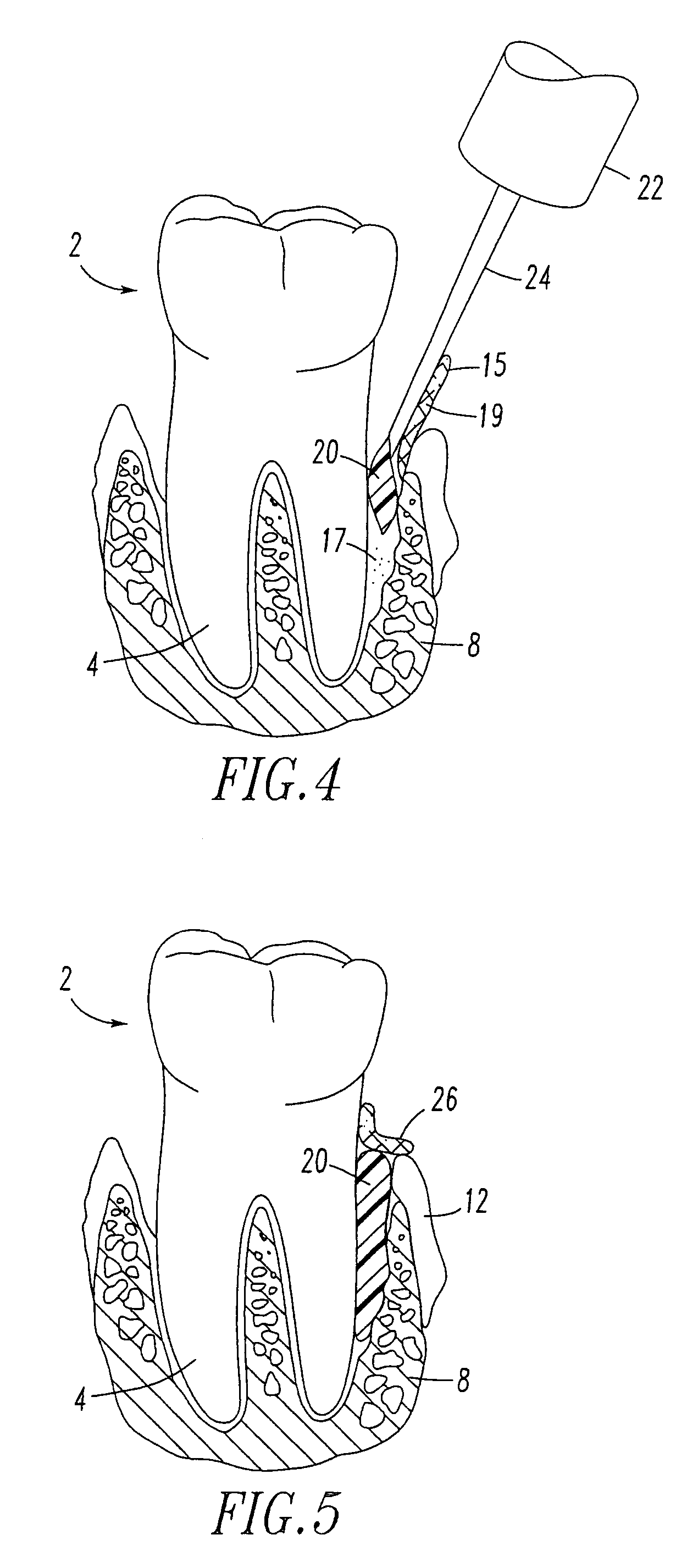 Periodontal regeneration composition and method of using same