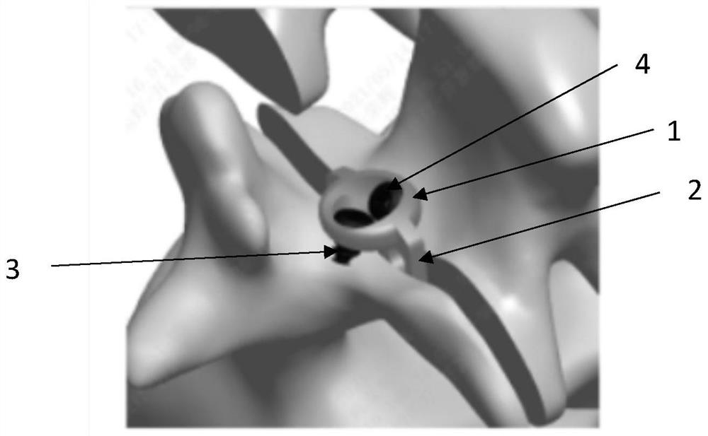 Vertebral plate replantation fixing device capable of grafting bone