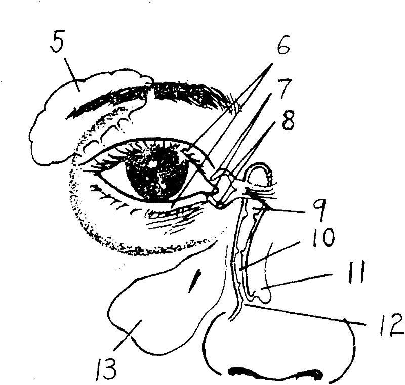 Application of medical silicone oil as medicament for treating lacrimal duct obstruction disease